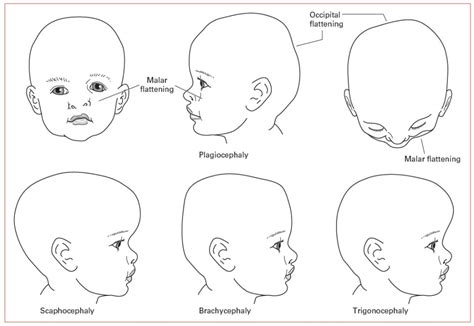 Craniofacial Anomalies | Obgyn Key