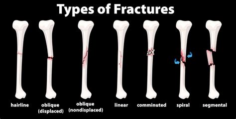 Causes, Symptoms and Treatment for Hairline Fracture | Zenith Injury and Wellness Relief Clinic