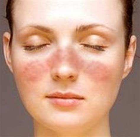 Rash on Face - Treatment, Causes, Pictures - HubPages