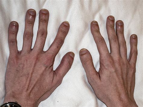 Clubbed fingers: Causes, symptoms, treatment, and when to seek help