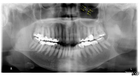 Anatomy Monday: Infraorbital Canal – Dr. G's Toothpix