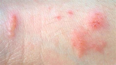 Pictures of common skin rashes, symptoms & treatments | GoHealth Urgent ...