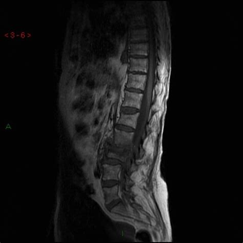 Cauda equina syndrome - wikidoc