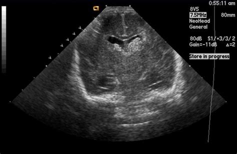 Germinal Matrix Hemorrhage Ultrasound