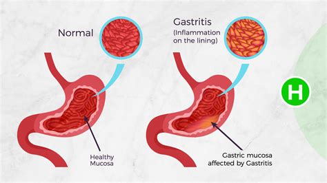 Gastritis Anatomy