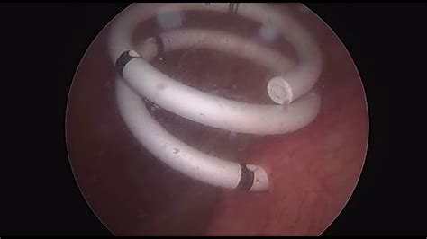 Attempt Consume curly blood in urine after stent insertion Away not to ...