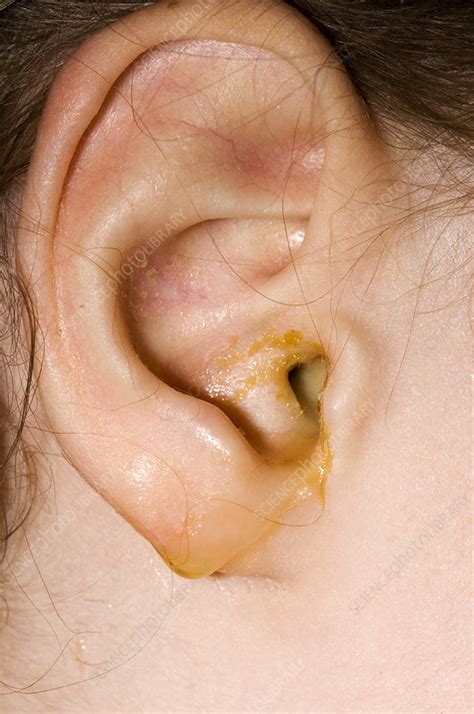 Ear infection - Stock Image - M157/0073 - Science Photo Library