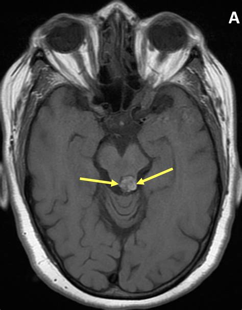 Cavernous Malformation - MRI Online