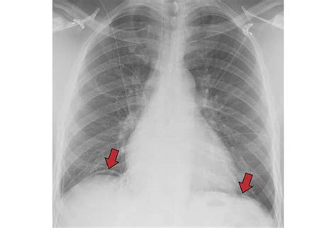 Chest X-Rays: 16 Subtle But Key Findings You Need to Know