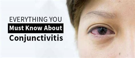 Everything You Must Know About Conjunctivitis