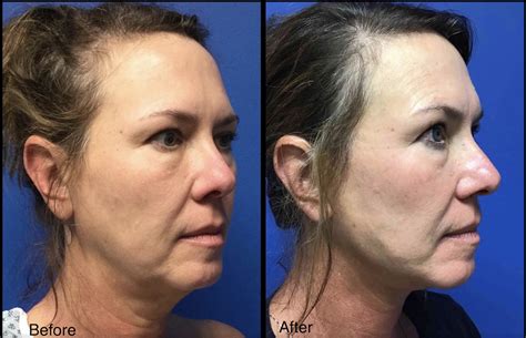 Woman with Face & Neck Lift - Before and After - Carolina Coastal ...