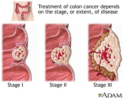 Blood In Stool Colon Cancer