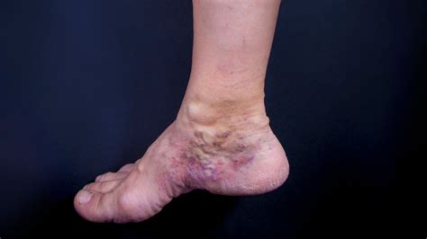 Top 5 Things to Know to Stop Varicose Vein Bleeding