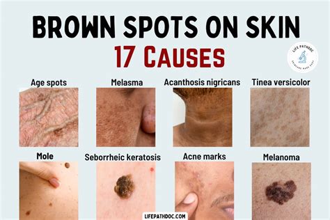 Brown Spots on Skin: 17 Causes, Pictures, Treatment