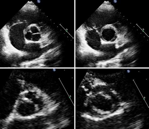 Aortic Valve Echo