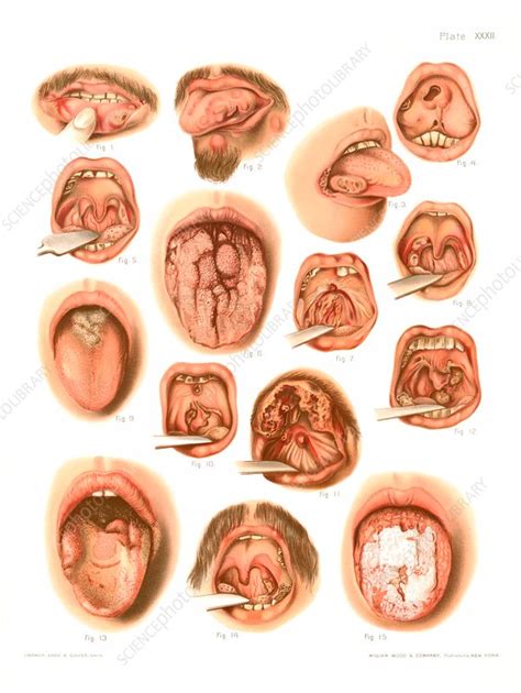 Tertiary syphilis lesions, illustration - Stock Image - C030/8454 ...