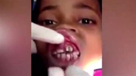 Video shows 15 maggots being removed from schoolgirl’s gums | news.com ...