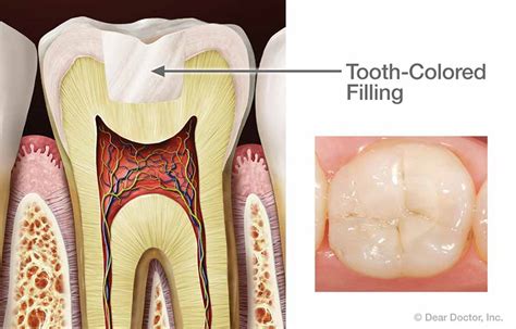 Tooth Cavity Filling