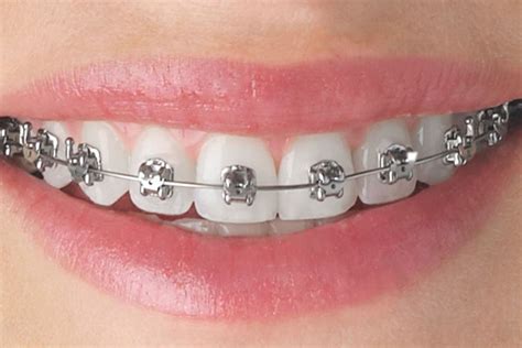 Metallic Braces - Teeth & Braces Clinic - Indore