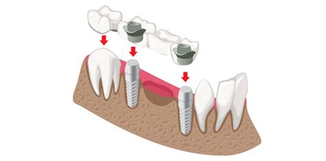 Dental Bridge in Port Coquitlam | Brookmere Dental Group