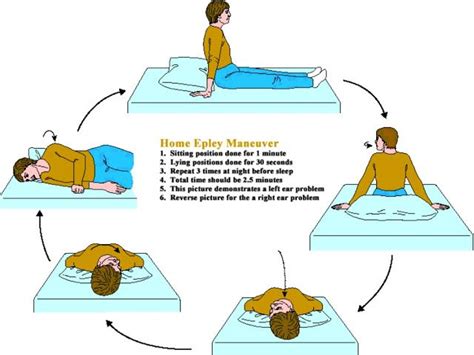 Vertigo Exercises Epley Maneuver Pdf - Image to u