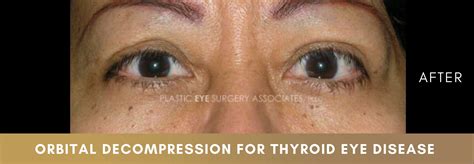 Thyroid Eye Disease - Plastic Eye Surgery Associates