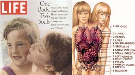 30 Interesting Things About Famous Conjoined Twins Abby And Brittany Hensel - Worldemand