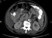 Intestinal malrotation | Radiology Reference Article | Radiopaedia.org ...