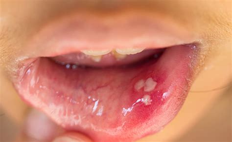 These 5 symptoms are seen in the body due to deficiency of Vitamin B12, blisters in the mouth ...