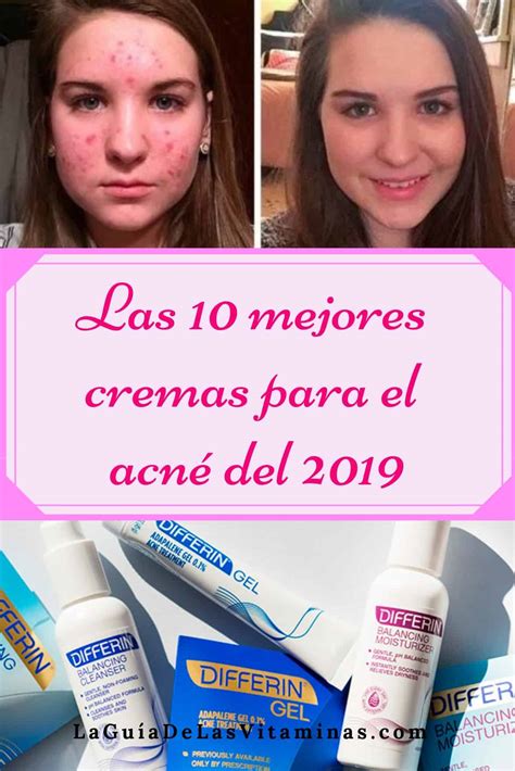 Las 10 mejores cremas para el acné del 2018 | La Guía de las Vitaminas