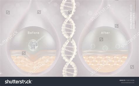 Hyaluronic Acid Before After Skin Solutions Stock Vector (Royalty Free) 1528124258 | Shutterstock