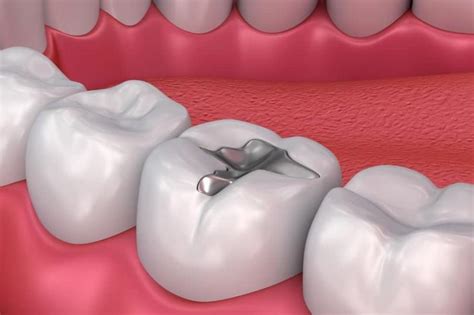 Mercury Poisoning Treatment Market with COVID19 Impact