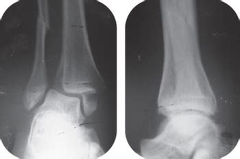 Bimalleolar fracture - WikiProjectMed