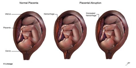 Postpartum Hemorrhage - Obstetrics - Medbullets Step 2/3