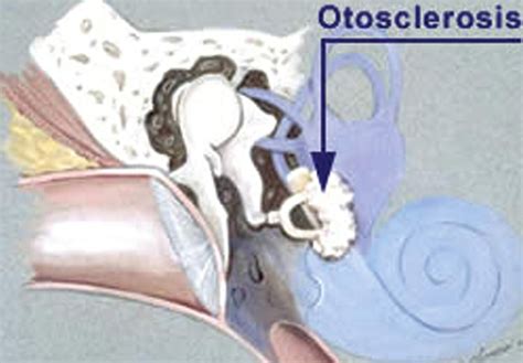 Otosclerosis - Types, Causes, Symptoms, Treatment and Prognosis