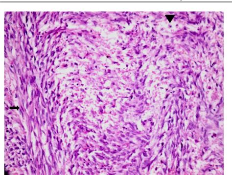 Figure 5 from Ovarian Fibrothecoma with Acute Torsion and Extensive Cystic Degeneration after ...