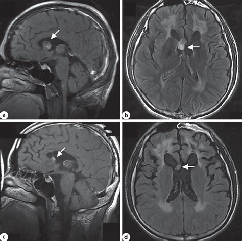 Figure 1 from A Case Report of Adult-Onset Alexander Disease with a Tumor-Like Lesion in the ...