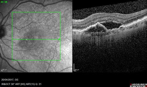 5 Macular Degeneration Facts | KindSIGHT Eye Specialists