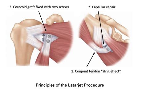 Latarjet Procedure | Shoulder Surgery | Sydney Shoulder Unit