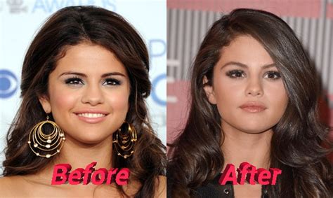 Selena Gomez Nose Job Plastic Surgery, Really?