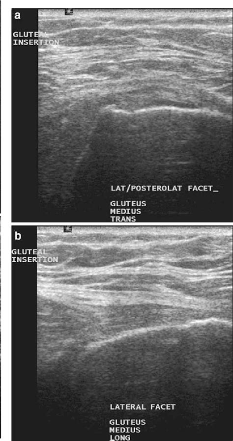 MRI and US of gluteal tendinopathy in greater trochanteric pain ...