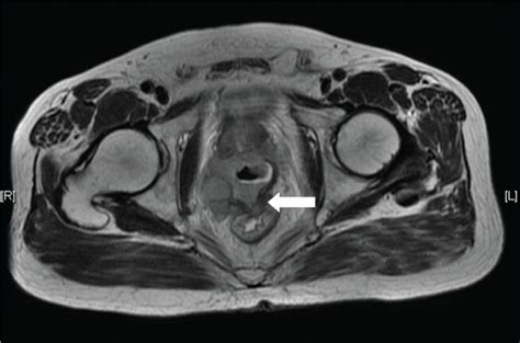 Prostate Lesions On Mri