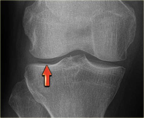 The Radiology Assistant : Meniscus special cases