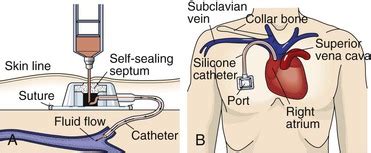 12 Central Venous Access Device Care | Nurse Key