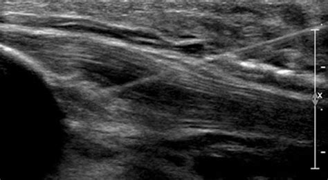 Percutaneous Needle Tenotomy - Welcome to Motion Is Medicine