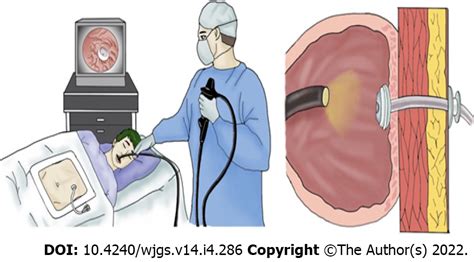 Percutaneous Endoscopic Gastrostomy (PEG) With T-fasteners, 52% OFF