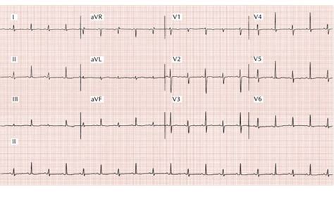 Electrical: Electrical Alternans