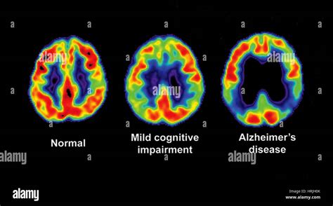 Normal, Impaired and Alzheimer Brain PET Scans Stock Photo - Alamy