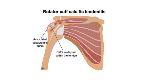 Calcific tendinitis and Barbotage | Musculoskeletal Ultrasound & Injections clinic