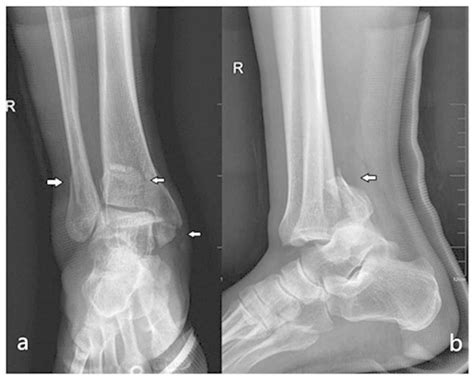 Plafond Vs Pilon Fracture